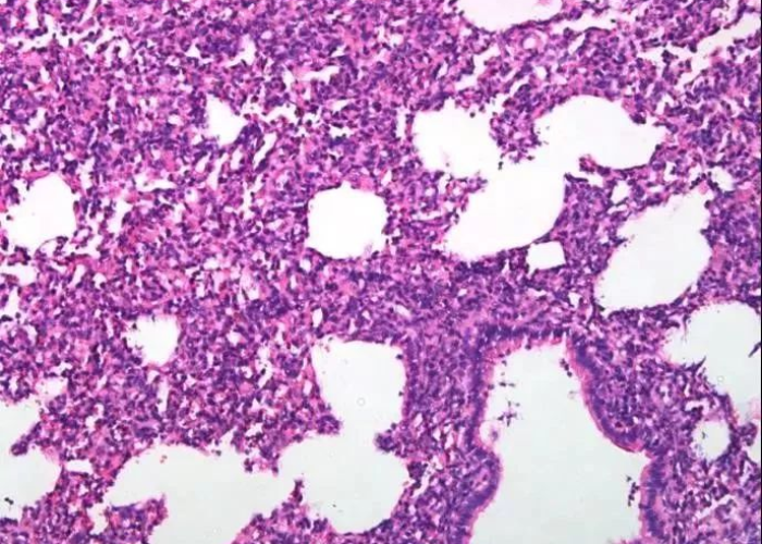 原创文章,间质性肺炎早期症状的隐匿信号与识别指南 原创文章,间质性肺炎早期症状的隐匿信号与识别指南