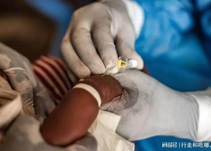 猴痘症状可以治愈吗 猴痘症状可以治愈吗