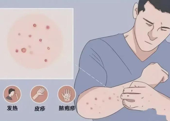 猴痘症状可以治愈吗 猴痘症状可以治愈吗